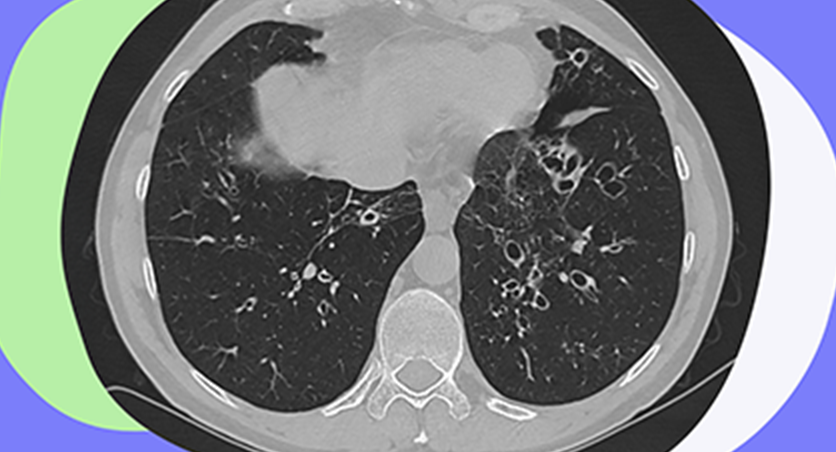 CT scan of bronchiectasis (BE)