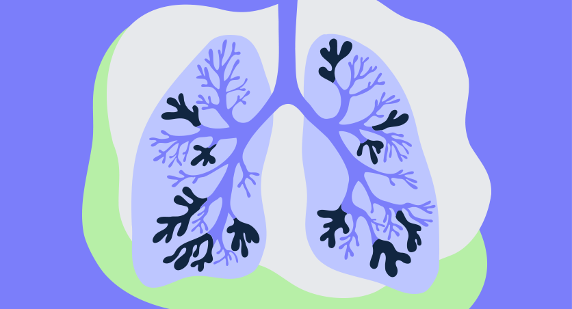 Bronchiectasis (BE) lungs illustration