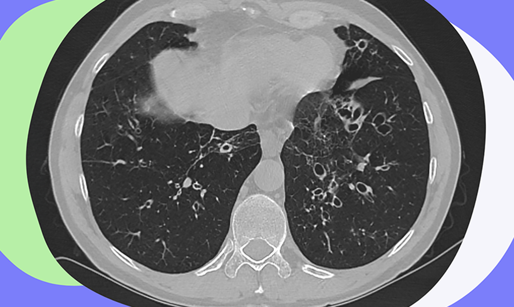 CT scan of bronchiectasis (BE)